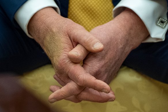 Hemorizos vistos en la mano de Trump.